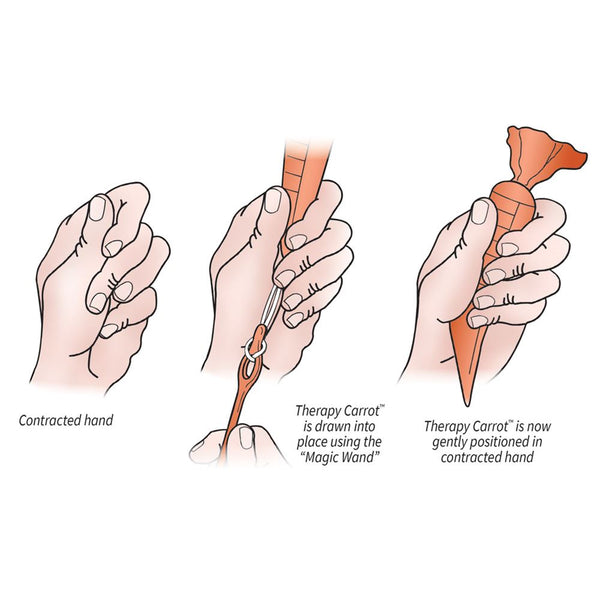 AliMed Original Therapy Carrot Hand Contracture Orthosis Kit Original Carrot Replacements: Large, Green 6/pk - 51027
