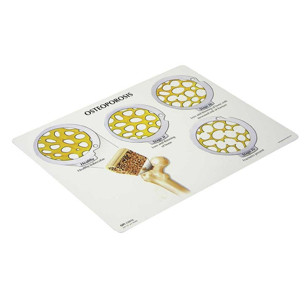GPI Anatomicals 4 Stage Osteoporosis Model 4 Stage Osteoporosis Model - 52475
