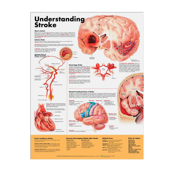 Alimed Anatomical Chart: Understanding Stroke Understanding Stroke Chart - 73355